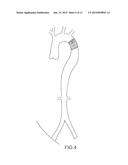 PERCUTANEOUS PROSTHETIC HEART VALVE diagram and image