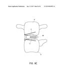 LATERAL INTERBODY FUSION DEVICES, SYSTEMS AND METHODS diagram and image