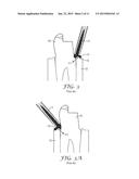 DEVICE AND A METHOD FOR DELIVERY OF A DENTAL COMPOSITION diagram and image