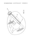 INTRODUCTORY ASSEMBLY AND METHOD FOR INSERTING INTRACARDIAC INSTRUMENTS diagram and image