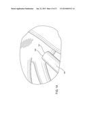 INTRODUCTORY ASSEMBLY AND METHOD FOR INSERTING INTRACARDIAC INSTRUMENTS diagram and image