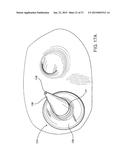 INTRODUCTORY ASSEMBLY AND METHOD FOR INSERTING INTRACARDIAC INSTRUMENTS diagram and image