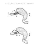 INTRALUMINAL DEVICE DELIVERY TECHNIQUE diagram and image