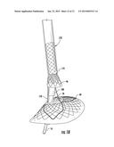 INTRALUMINAL DEVICE DELIVERY TECHNIQUE diagram and image