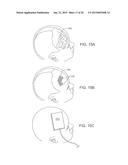 SYSTEMS, METHODS AND DEVICES FOR A SKULL/BRAIN INTERFACE diagram and image