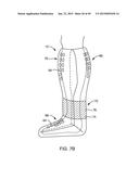 SYSTEMS AND METHODS FOR PROVIDING AN ORTHOPEDIC FOOT SUPPORT diagram and image