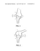 DEVICE AND METHOD FOR INSTALLING FEMORAL PROSTHETIC KNEE JOINT diagram and image