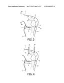DEVICE AND METHOD FOR INSTALLING FEMORAL PROSTHETIC KNEE JOINT diagram and image