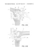 DEVICE AND METHOD FOR INSTALLING FEMORAL PROSTHETIC KNEE JOINT diagram and image