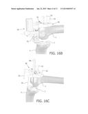 DEVICE AND METHOD FOR INSTALLING FEMORAL PROSTHETIC KNEE JOINT diagram and image