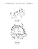 DEVICE AND METHOD FOR INSTALLING FEMORAL PROSTHETIC KNEE JOINT diagram and image