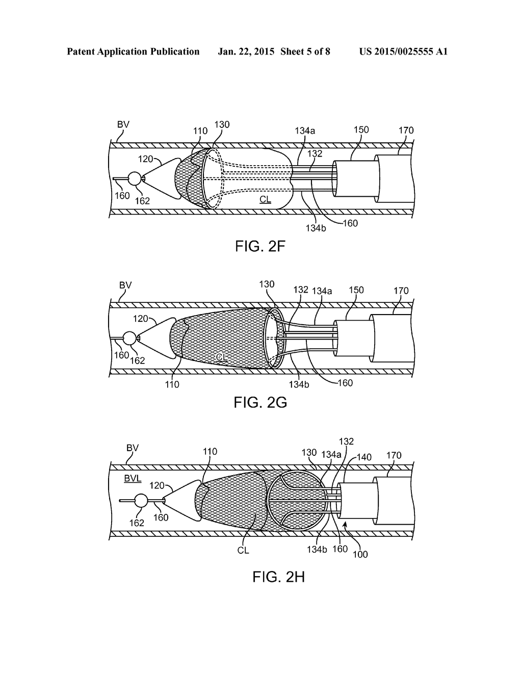 Thrombus Removal and Intravascular Distal Embolic Protection Device - diagram, schematic, and image 06