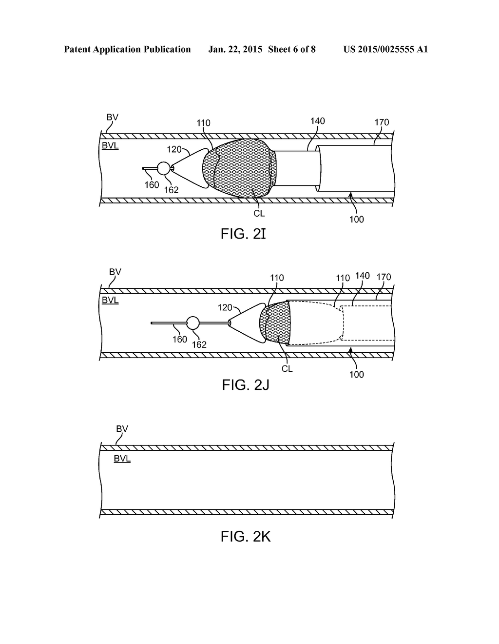 Thrombus Removal and Intravascular Distal Embolic Protection Device - diagram, schematic, and image 07