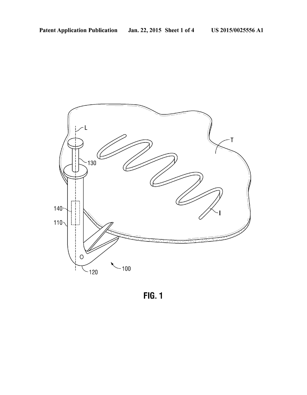 INCISIONAL HERNIA CUT LINE METHOD AND DEVICE - diagram, schematic, and image 02