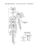 LONGITUDINAL CONNECTING MEMBER WITH SLEEVED TENSIONED CORDS diagram and image