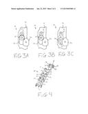 Orthopedic Plating Assembly For Bone Fixation and Subsidence diagram and image