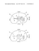 FEMORAL KNEE PROSTHESIS WITH DIVERGING LATERAL CONDYLE diagram and image