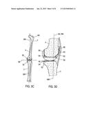 FEMORAL KNEE PROSTHESIS WITH DIVERGING LATERAL CONDYLE diagram and image