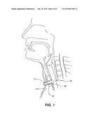 Tracheostomy Appliances and Methods for the Treatment of Sleep Apnea     Syndromes diagram and image