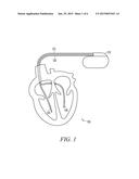 LEAD ASSEMBLY WITH POROUS POLYETHYLENE COVER diagram and image