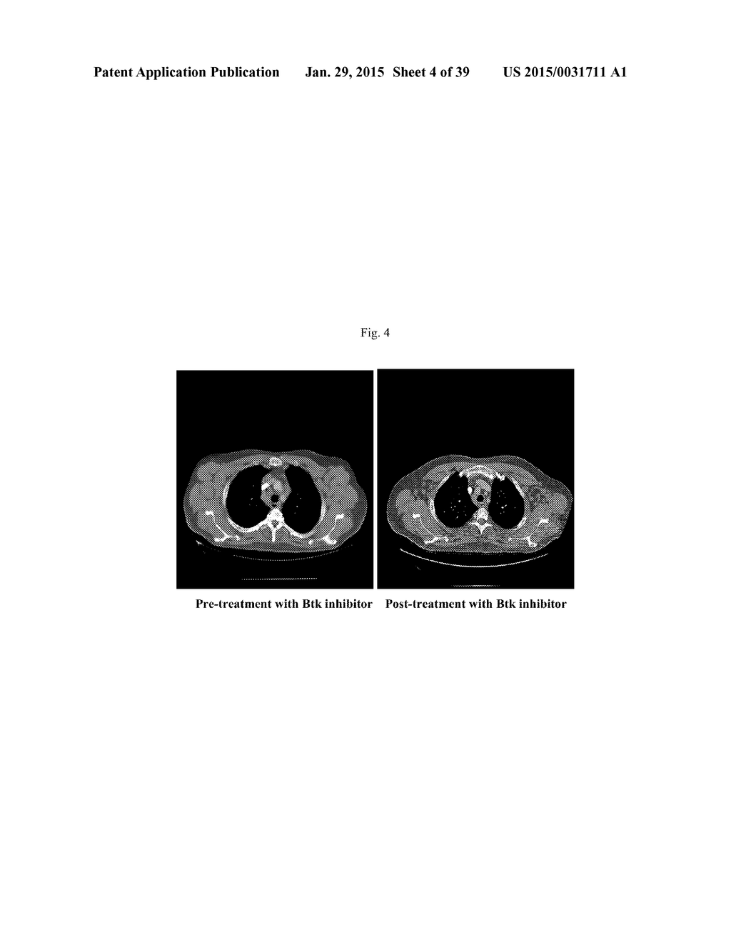 USE OF INHIBITORS OF BRUTON'S TYROSINE KINASE (BTK) - diagram, schematic, and image 05