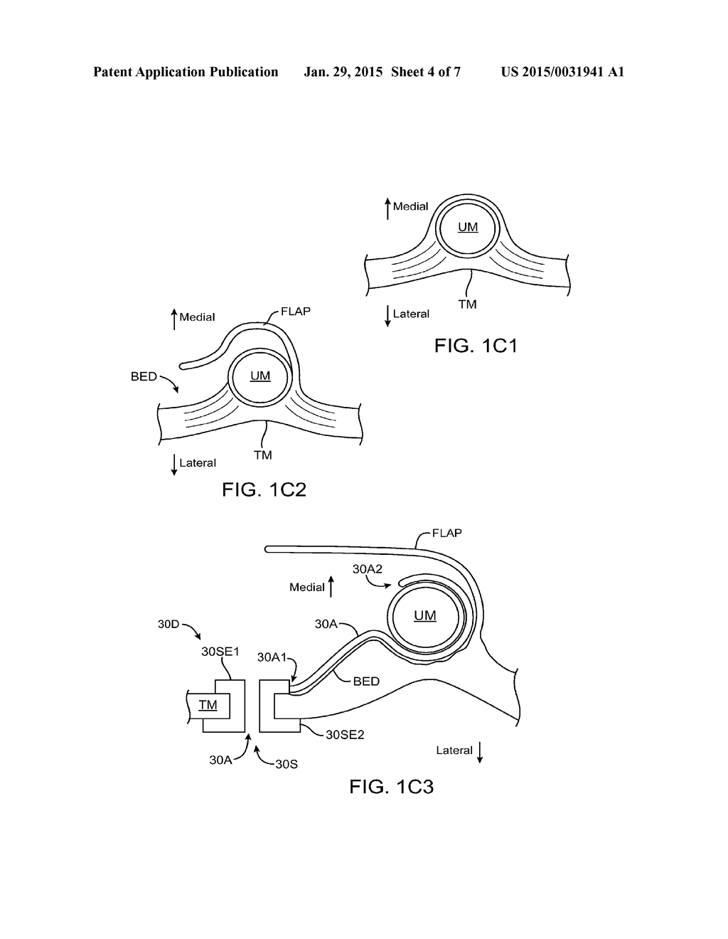 Eardrum Implantable Devices for Hearing Systems and Methods - diagram, schematic, and image 05