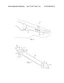 INTRAMEDULLARY FIXATION DEVICE AND METHODS FOR BONE FIXATION AND     STABILIZATION diagram and image