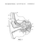 Cochlear Implant Electrode Insertion Support Device diagram and image