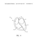 TRANSAPICAL MITRAL VALVE REPAIR METHOD diagram and image