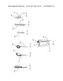 TRANSAPICAL MITRAL VALVE REPAIR METHOD diagram and image