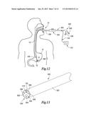 TISSUE APPOSITION CLIP APPLICATION METHODS diagram and image
