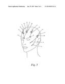 Cosmetic Implant diagram and image