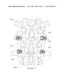 Percutaneous Pedicle Screw Revision System diagram and image