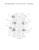 Percutaneous Pedicle Screw Revision System diagram and image