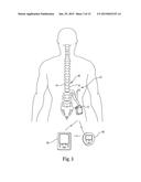 LOW INSERTION FORCE ELECTRICAL CONNECTOR FOR IMPLANTABLE MEDICAL DEVICES diagram and image