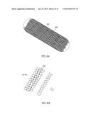 CAROTID STENT ASSEMBLY AND METHODS FOR TREATMENT VIA BODY LUMENS diagram and image