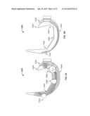 COMPLIANT ANTI-RESORPTION IMPLANT diagram and image