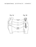 Prosthetic Devices and Implants diagram and image