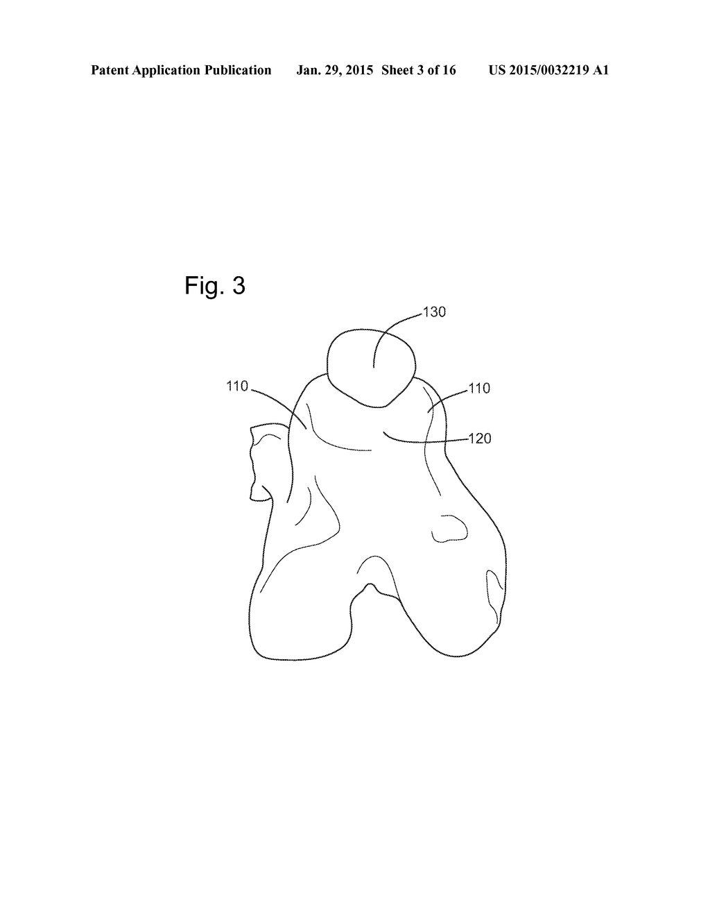 Prosthetic Devices and Implants - diagram, schematic, and image 04