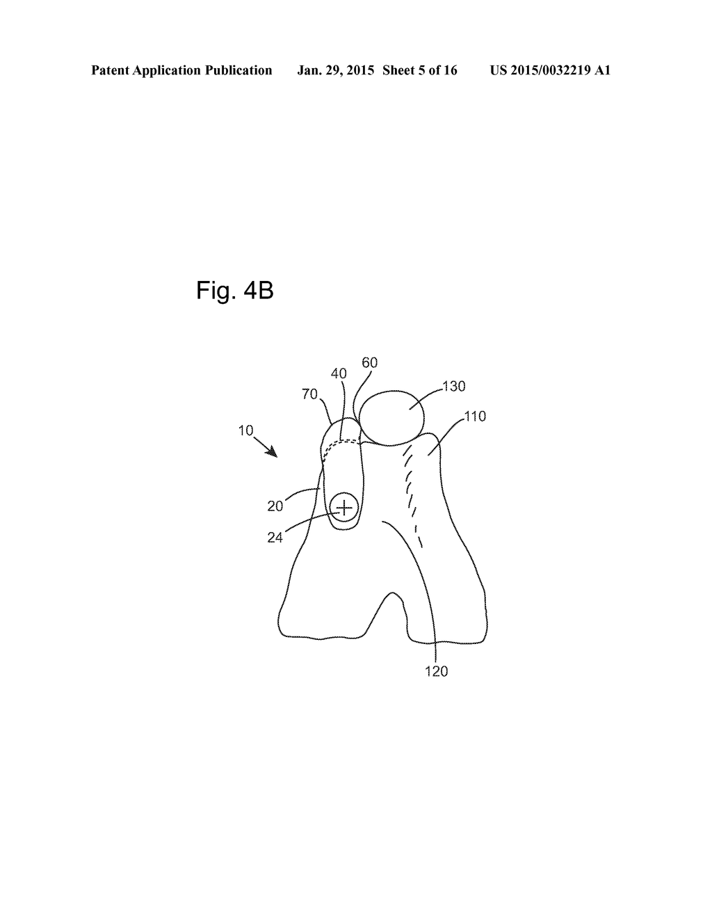 Prosthetic Devices and Implants - diagram, schematic, and image 06