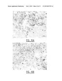 METHOD FOR IDENTIFYING A SUBJECT AT RISK OF DEVELOPING HEART FAILURE BY     DETERMINING THE LEVEL OF GALECTIN-3 OR THROMBOSPONDIN-2 diagram and image