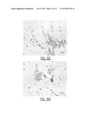 METHOD FOR IDENTIFYING A SUBJECT AT RISK OF DEVELOPING HEART FAILURE BY     DETERMINING THE LEVEL OF GALECTIN-3 OR THROMBOSPONDIN-2 diagram and image