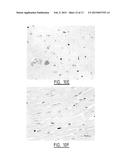 METHOD FOR IDENTIFYING A SUBJECT AT RISK OF DEVELOPING HEART FAILURE BY     DETERMINING THE LEVEL OF GALECTIN-3 OR THROMBOSPONDIN-2 diagram and image