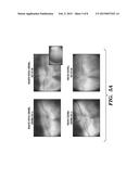 COMPOSITIONS AND METHODS FOR OCULAR DELIVERY OF A THERAPEUTIC AGENT diagram and image