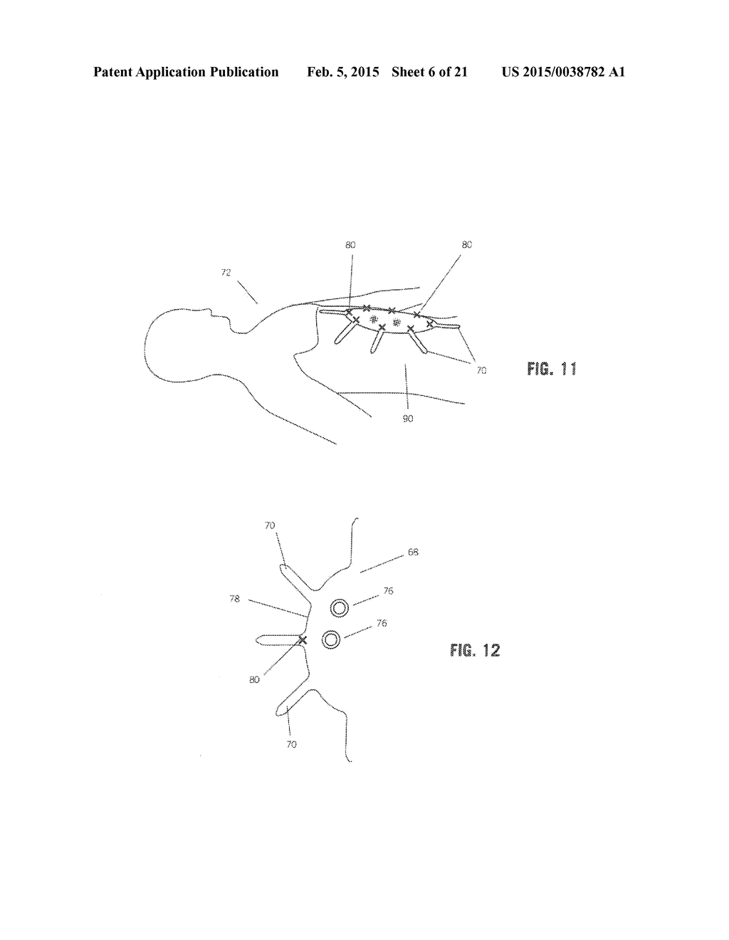 IMPLANT FOR HERNIA REPAIR - diagram, schematic, and image 07