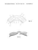 IMPLANT FOR HERNIA REPAIR diagram and image