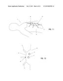 IMPLANT FOR HERNIA REPAIR diagram and image