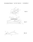 IMPLANT FOR HERNIA REPAIR diagram and image