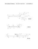 IMPLANT FOR HERNIA REPAIR diagram and image