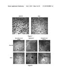 MEIBOMIAN GLAND DYSFUNCTION diagram and image